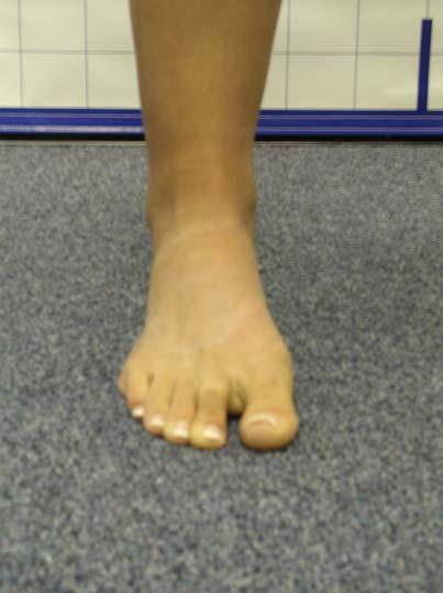 Foot & Ankle: Foot Turns Out External Rotation Straight Normal Abnormal Foot Turns
