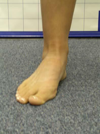 In a normal foot the 1st MTP joint will appear along the same plane as the medial