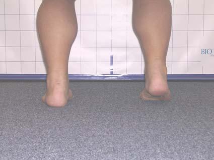 Foot & Ankle: Heel of Foot Rises Normal Abnormal Heel of Foot Rises: Note the heel of the foot rising off of the floor.
