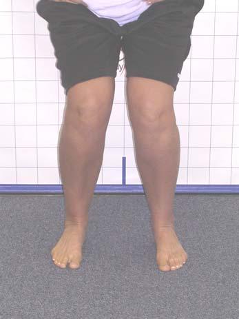 Knee: Moves Inward Normal Abnormal Knee Moves Inward: Note a line drawn from the patellar tendon which bisects the ankle.