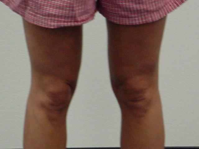 Adducted Knees Probable Shortened Muscles: