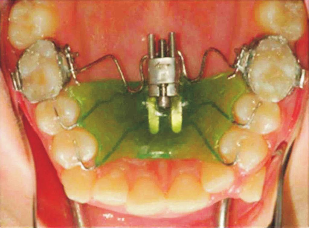 INTRODUCTION Maxillary molar distalization is a frequently preferred nonextraction treatment option for patients with Class II malocclusion.