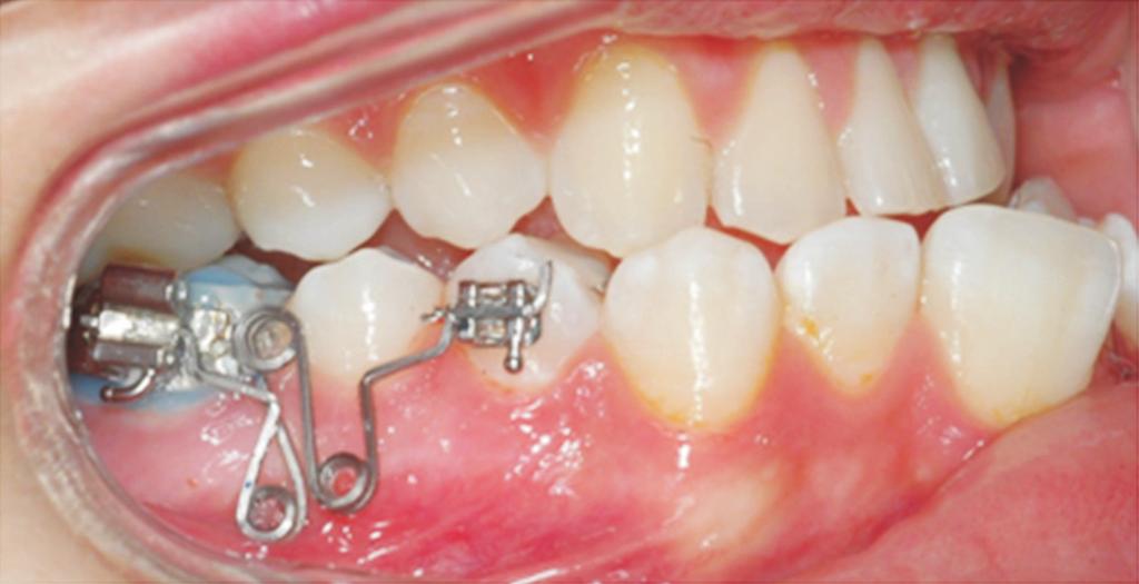 were attached to the Nance appliance using a 0.8- mm stainless steel wire. The occlusal rests lied in the embrasures mesial to the anchor teeth.