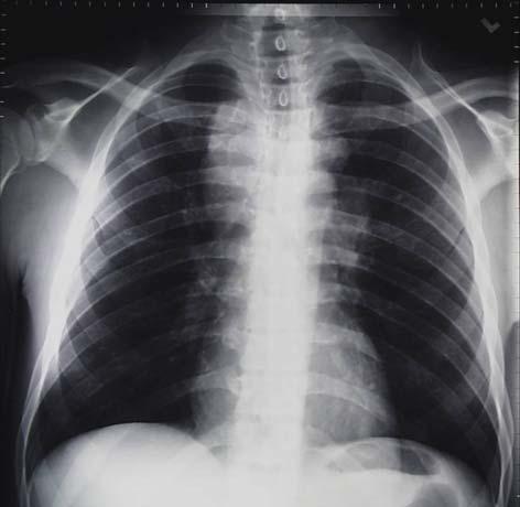 Question Which x-ray is more likely to be from a patient that has