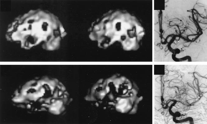 AJNR: 24, March 2003 CEREBRAL VASOSPASM 449 FIG 4. Serial changes in cortical rcbf in a case with DIND.