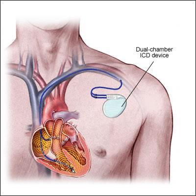 Implantable Cardiac Defibrillators (ICD) Sustained ventricular tachycardia is associated with sudden cardiac death in HF.