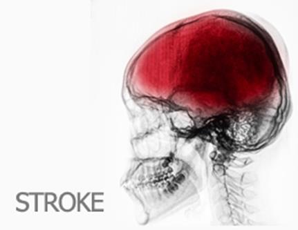 The equivalent risk after a first-ever ischemic stroke is usually reported as 2% to 6% Approximately 2% 5% of recurrent stroke occurred early within 24 48 hours after the index
