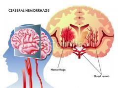 After haemorrhagic stroke: The annual risks of recurrent intracerebral haemorrhage and ischaemic stroke are similar, from 1 3% to 7 4% The risk of recurrent intracerebral haemorrhage