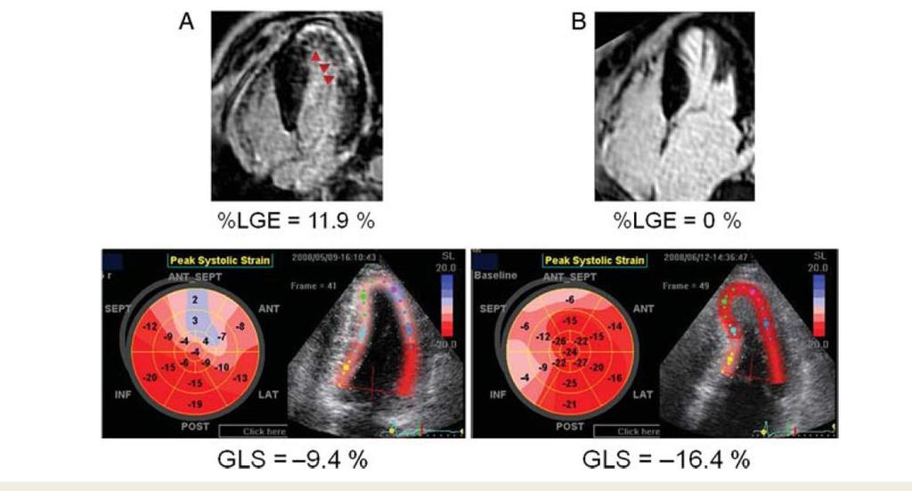 Association of GLS with fibrosis in HCM Fibrosis related to risk of