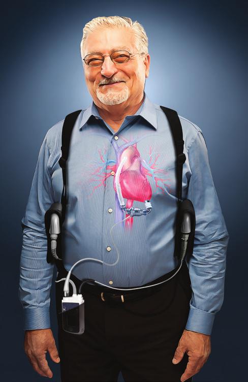 Understanding HeartMate II HeartMate II is a system that helps your heart send blood with oxygen and nutrients to the rest of your body HeartMate II is a left ventricular assist device, or LVAD 9 It