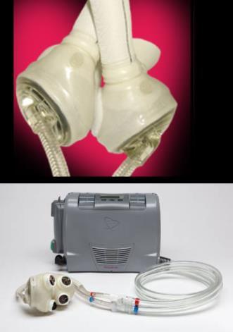 Total Artificial Heart Mr P S, 50 years ans 71 kg 1m70