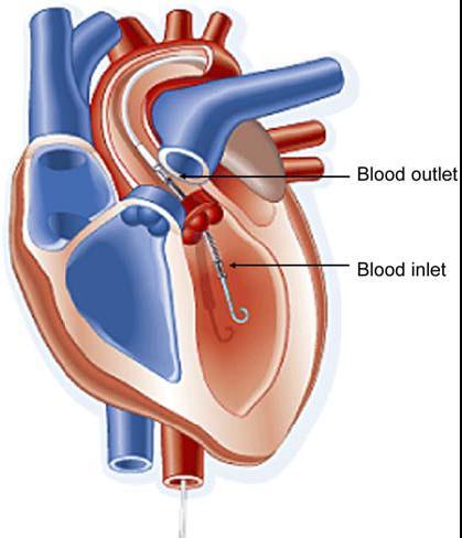 cardiogenic shock Chronic decompensated heart failure