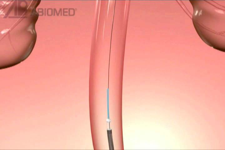 Impella Recover Miniaturized rotary blood pump (axial flow) Provides up to 2.5 (percutaneous) or 5.