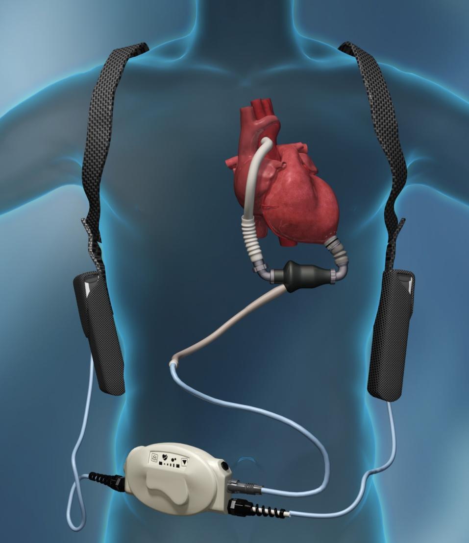 HeartMate II LVAS System Components HM II Components: Implantable titanium blood pump System Controller Shared