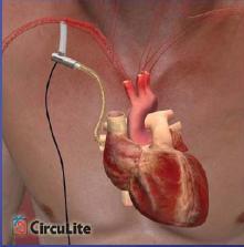 Partial ventricular support Patient Design Procedure CircuLite Class IIIb