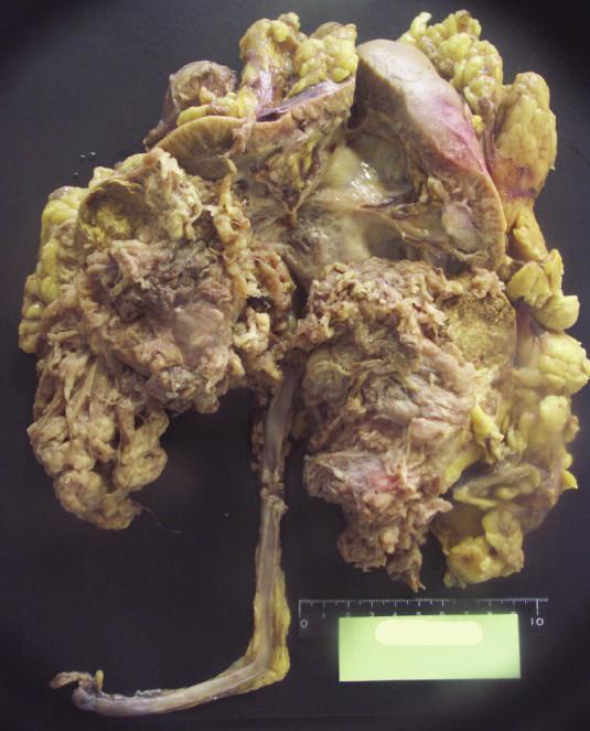 (b) The resected kidney contained a brownish and fragile tumor in the lower half (Case 2).