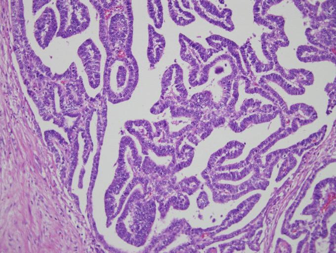 The nuclei were oval in shape with fine chromatin and inconspicuous nucleoli. The cytoplasm was scanty. from the conventional papillary RCC.