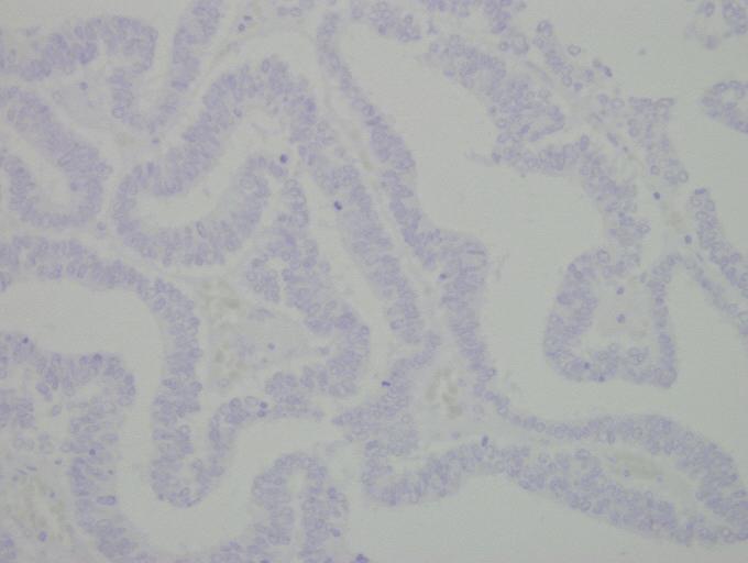 Psammoma bodies are frequently seen. Characteristically, the translocation RCC shows aberrant nuclear immunoreactivity for TFE3, the product of TFE3 gene located on Xp11.2 [9].