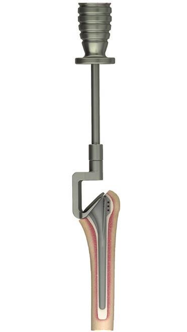 utilizing the Humeral Forked Stem Extractor and Universal Slap Hammer after each