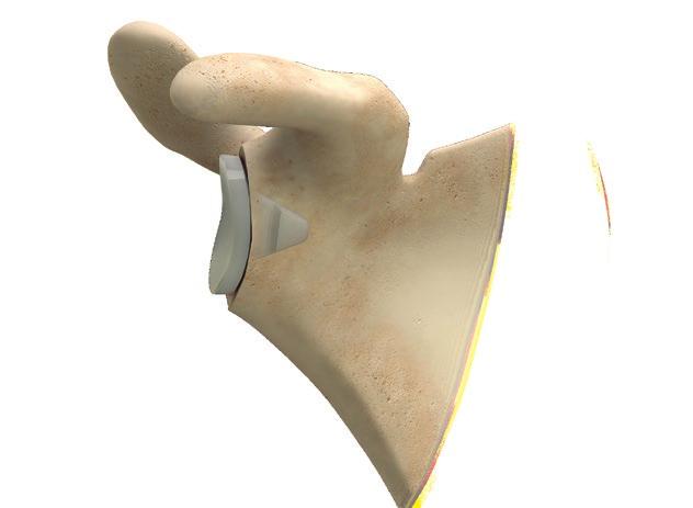 GLENOID COMPONENT REMOVAL CEMENTED