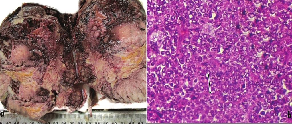C-126 Wilms Tumour with Neural Differentiation Introduction Wilm s tumour is the most common malignant renal tumour of childhood. It presents most commonly between the age groups of 1 to 6 years.