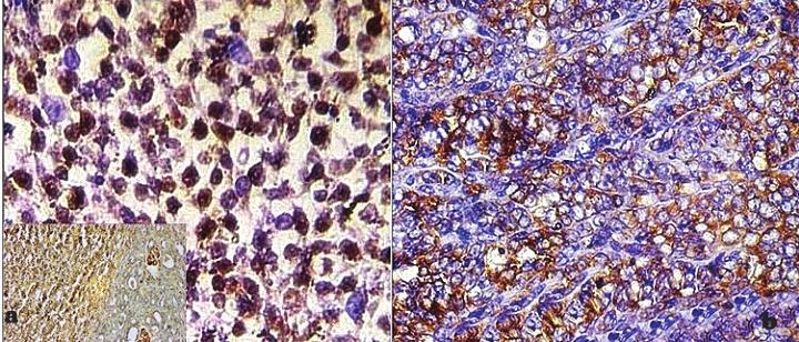 Singh et al. C-127 Fig. 2. a.diffuse WT1 nuclear positivity expressed by tumour cells (IHC 40X),inset showing WT1 positive tumour with adjacent renal parenchyma.b.tumor cells showing cytoplasmic positivity for synaptophysin (IHC 40 X).