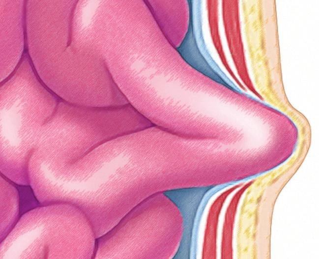 How does a hernia develop? Although a hernia bulge may appear suddenly, hernias often take years to develop.