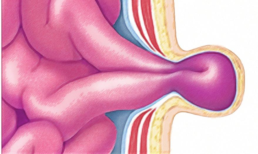 Groin hernias Groin hernias are the most common types of hernias. The intestine pushes into the sac As the intestine pushes further into the sac, it forms a visible bulge.