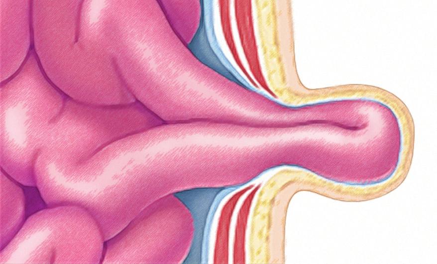 The intestine may get trapped The sac containing the intestine may get trapped by muscles (incarcerated). If this happens, you won t be able to flatten the bulge.