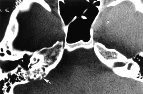 Companion Patient 1: CT Findings CT through the petrous ridge demonstrates bone erosion at the site of the endolymphatic sac
