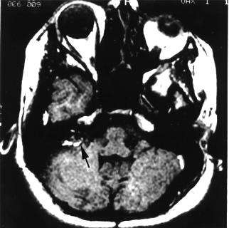 Companion Patient 1: MR Images T1 MRI demonstrates