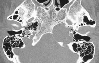 Companion Patient 2: CT Images Axial CT demonstrates a