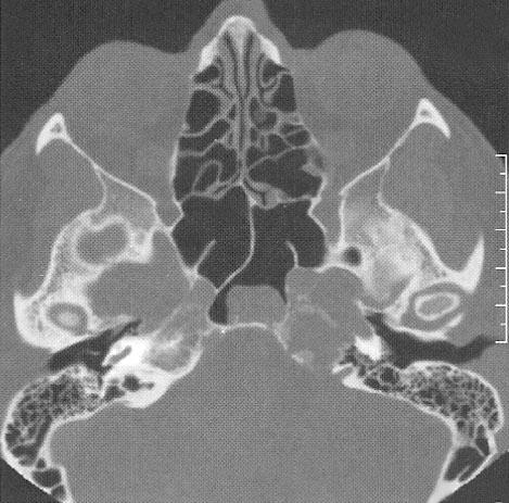 Companion Patient 4: CT Images Axial CT showing a