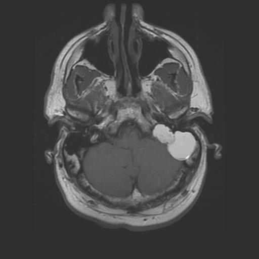 Our Patient AI: Axial MRI Findings MR T1 Axial Image Heterogeneous 4.5 x 2.0 x 3.