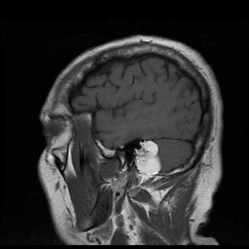 Our Patient AI: Sagittal MR Sagittal MR T1WI showing a