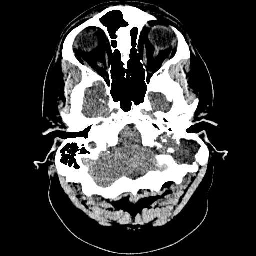 Our Patient AI: Initial Imaging Findings Axial CT, patient AI Image Source: BIDMC (PACS) Heterogeneous erosive mass