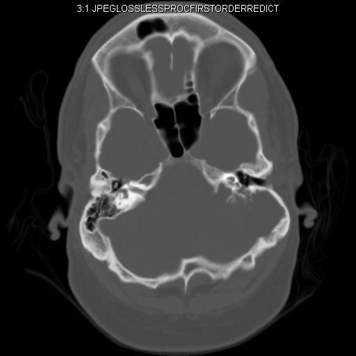 Our Patient AI: CT and CT-A Findings Axial CT