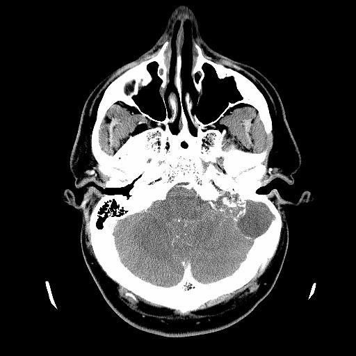 posterior left temporal bone CT-Angiogram