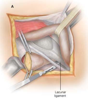 Femoral Hernias Approach