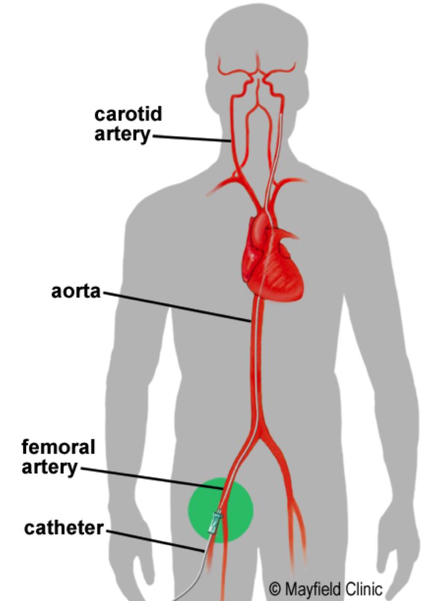 5 Figure 3. Angiogram shows a catheter in the internal carotid artery. A flush of dye shows blood filling an aneurysm. Figure 2.