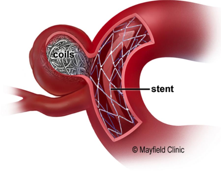 6 aneurysm. The stent remains in the artery permanently holding the coils in place. In some cases, a flow-diversion stent may be used.