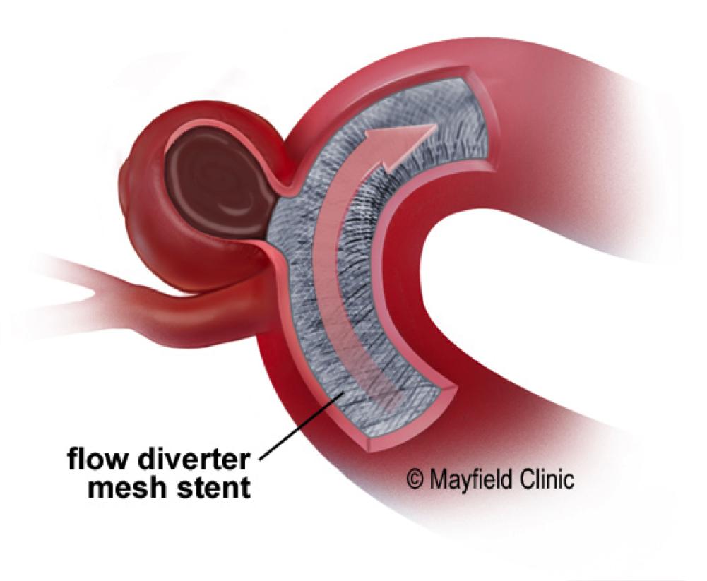 Because blood cannot easily get through the spaces of the tight mesh stent, the blood flows inside the flowdiverter and continues down the artery without going into the aneurysm.