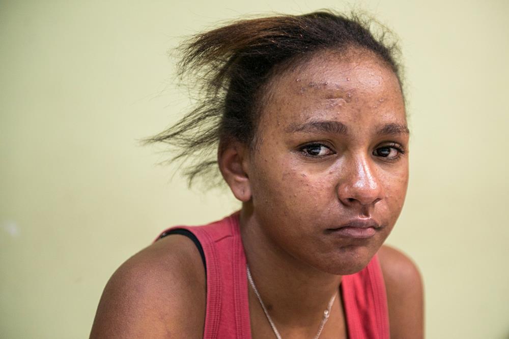 Skin lesions or rash After her fever and joint pain diminished, this teenager came to the clinic to have her skin checked.