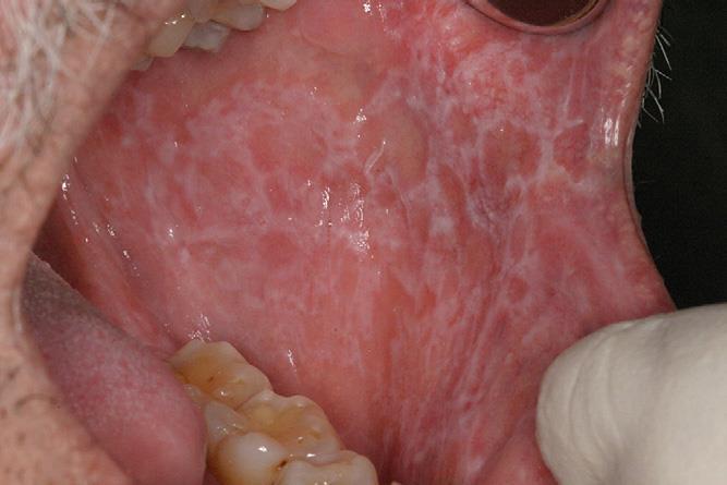 Oral (Mucosal) Lichen Planus Clinical 1-2% of the general population; 50-77% of