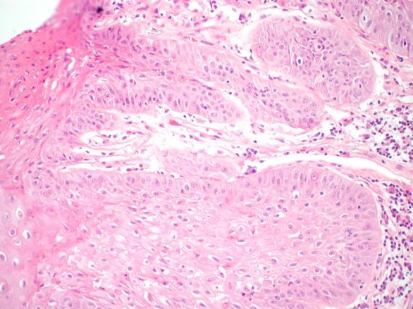 carcinoma Higher risk of recurrence Possible