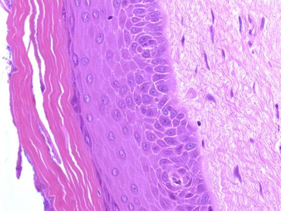 Keratinizing Squamous Lesions Keratin = abnormal (nearly always) Surface keratinization Dyskeratosis Pink Cell Change 16 Keratinizing
