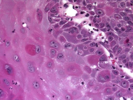 Pink cell change Diagnosing Keratosis Keratosis with dysplasia If you can, grade