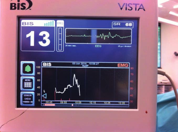 8 AAGA Depth during of anaesthesia induction monitoring of anaesthesia and transfer into theatre 20.