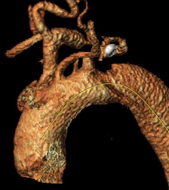 Hata M, Shiono M, Inoue T, Sezai A, Niino T, Negishi N, Sezai Y. Optimal treatment of type B acute aortic dissection: long-term medical follow-up results. Ann Thorac Surg.