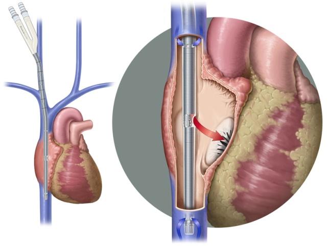 Based on double lumen VV ECMO, the DLC is designed to be inserted from the jugular vein traversing the SVC-RA-IVC.